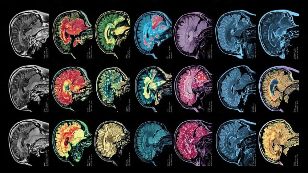 Featured image for Brain Tumor Classification Using InceptionV3 and Grad-CAM: A Deep Learning Pipeline article